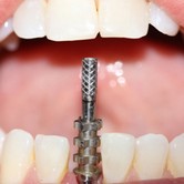 Low Cost Dental Implants In Tijuana